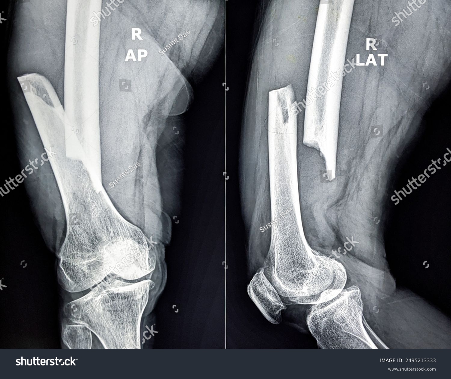 X-ray femur fracture